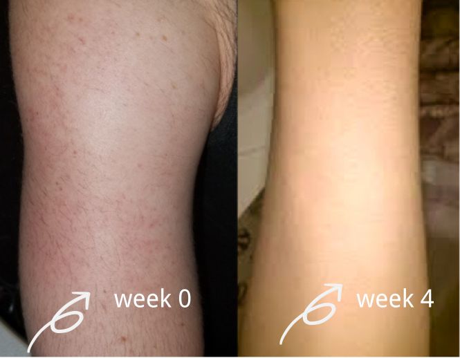 salloot hair removal before and after for arm
