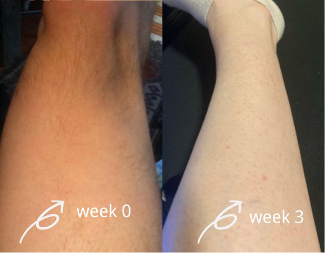 salloot hair removal before and after for legs