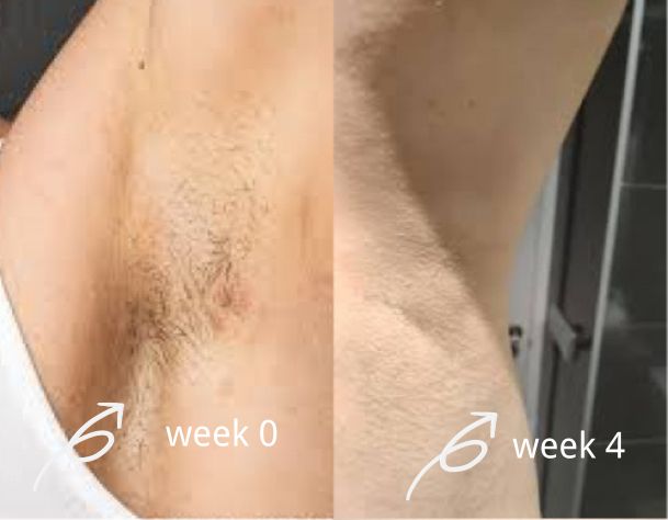 salloot hair removal before and after for armpits
