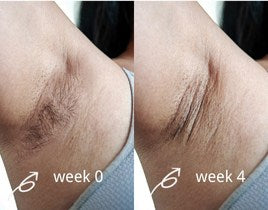 salloot hair removal before and after for armpits