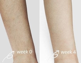 salloot hair removal before and after for hands
