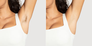 Home IPL Laser Hair Removal: It works?